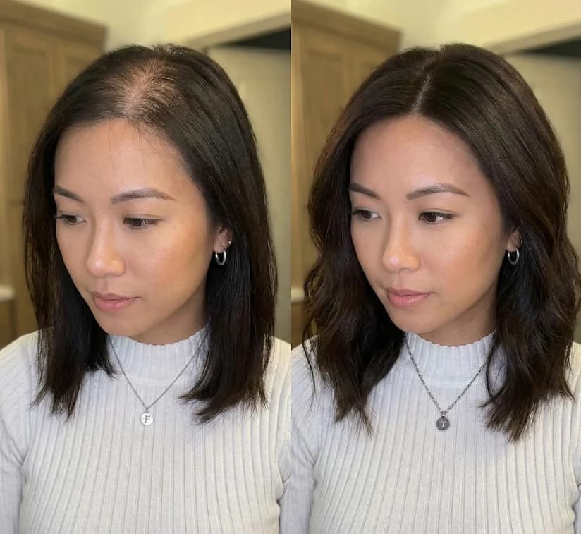 Patient after FUE hair transplant at Nexus Clinic Malaysia — hair smoothed and skin texture refined